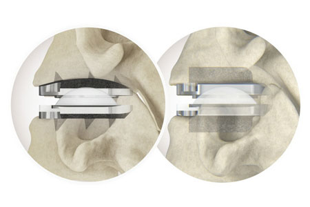 Centinel Spine's prodisc® C Vivo and prodisc C SK Cervical Total Disc Replacement System 