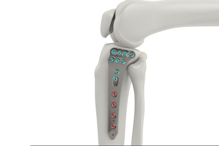 Tyber Medical Acquires FDA Clearance for Proximal Tibia Plating System 