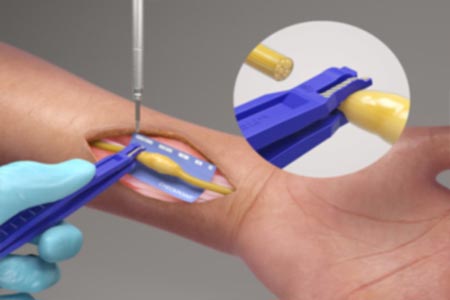 Surgical launches Checkpoint Edge™ Nerve Cutting Kit